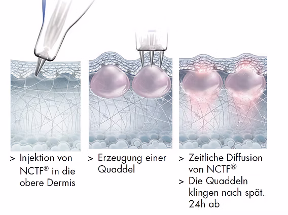 Mesotherapy Dresden