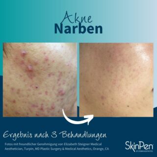 SKINPEN JUNI POSTS 2023 - DE - POST 12 [3.7]