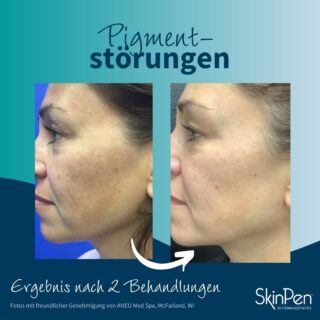 SKINPEN JUNI POSTS 2023 - DE - POST 12 [5.7]