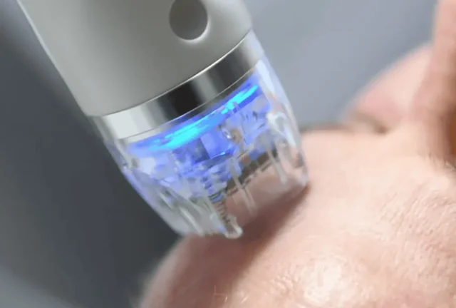 RF Microneedling Dresden